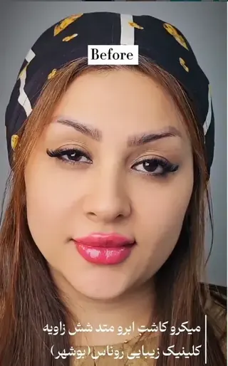 قبل از میکروکاشت ابرو متد شش‌زاویه