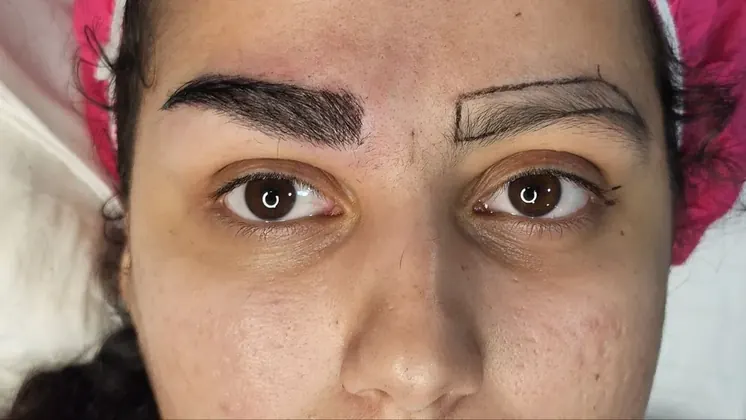 طراحی ابرو پیش از کاشت در کلینیک روناس