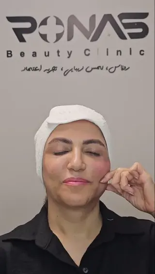 بعد از اندولیفت خط فک و غبغب