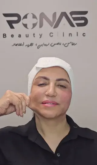 قبل از اندولیفت خط فک و غبغب