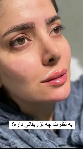 بعد از تزریق فیلر لب و خط فک