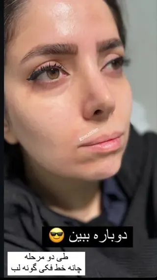 قبل از تزریق فیلر لب و خط فک